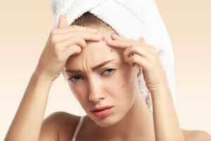 Read more about the article Acne Myth